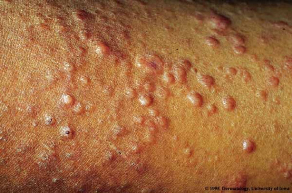 Tổn thương da do bệnh phong có thể là nhiều nốt sần thay đổi màu sắc, có đi kèm với cảm giác tê bì. (nguồn: pinterest.com)
