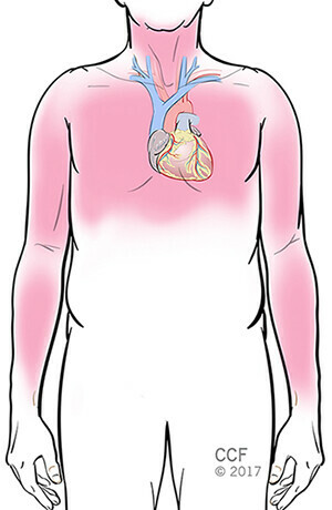 Vị trí các triệu chứng của cơn nhồi máu cơ tim. (Nguồn ảnh my.clevelandclinic.org)