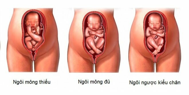 Ngôi ngược là tư thế gây khó khăn nhất khi đẻ thường, thường chỉ định mổ lấy thai. Nguồn: lamchame.vn