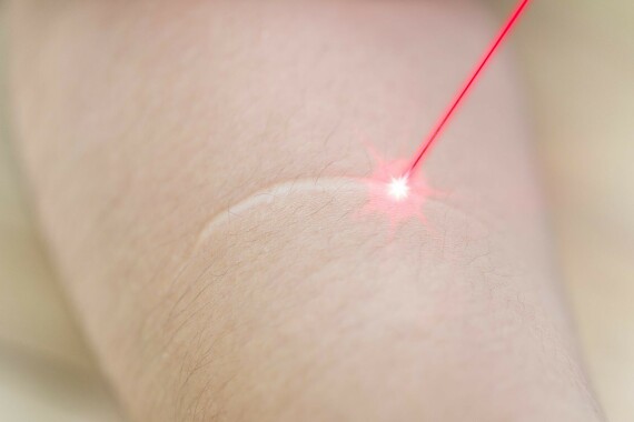  Liệu pháp Laser điều trị sẹo. Nguồn: WebMD
