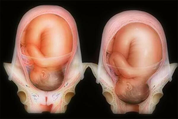Có khả năng sinh con bình thường khi bị cổ tử cung hở ngoài không?

