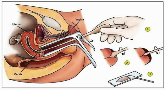  Xét nghiệm Pap. Một mỏ vịt được đưa vào âm đạo để mở rộng nó. Sau đó, một bàn chải được đưa vào âm đạo để thu thập các tế bào từ cổ tử cung. Các tế bào được kiểm tra dưới kính hiển vi để tìm các dấu hiệu của bệnh.