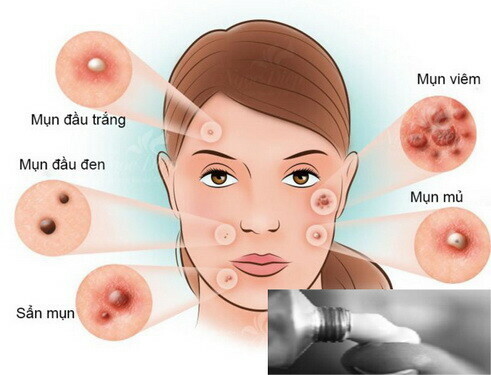 Thêm một lựa chọn điều trị cho người bị mụn trứng cá