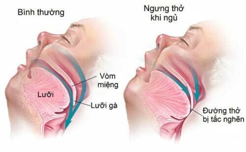 Chứng ngưng thở khi ngủ . Nguồn: almurshidimed.com