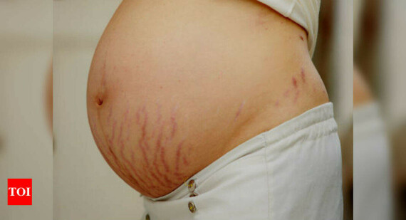 Rau má có thể ngửa rạn da trong thai kì, nguồn ảnh timesofindia.indiatimes.com