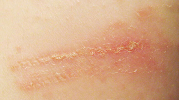 Viêm da do tiếp xúc với chất gây dị ứng. Nguồn ảnh: healthline.com