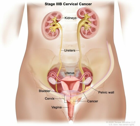 Giai đoạn IIIB ung thư cổ tử cung. Ung thư đã lan đến thành chậu và / hoặc khối u đã trở nên đủ lớn để chèn ép một hoặc cả hai niệu quản hoặc khiến một hoặc cả hai thận to hơn hoặc ngừng hoạt động.
