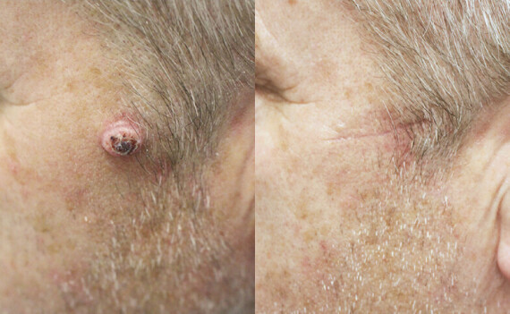 Phẫu thuật cắt bỏ khối u trên da là một phương pháp điều trị ung thư, nguồn ảnh skinsurgeryclinic.co.uk