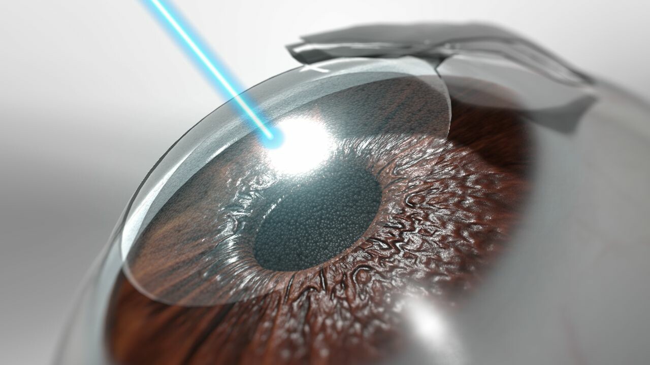 Phẫu thuật LASIK (dùng tia laser bào mòn giác mạc). Nguồn ảnh: UCIHealth