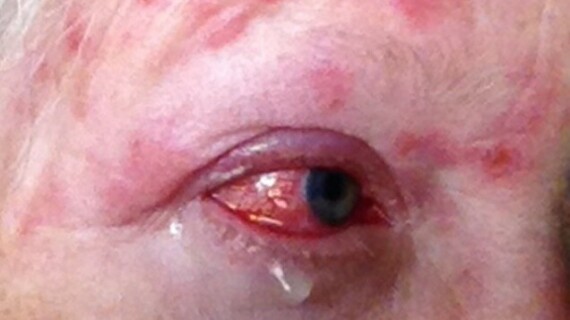 Biến chứng ở mắt là biến chứng nghiêm trọng của bệnh zona thần kinh. Nguồn ảnh: healthline.com