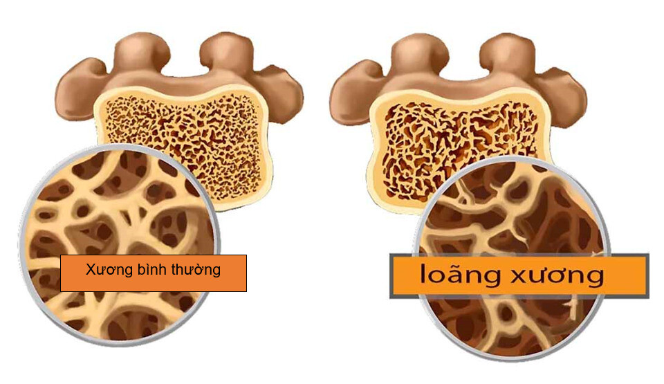 Loãng xương làm giảm mật độ và chất lượng xương, làm xương dễ gãy hơn. Nguồn: Doctors24h