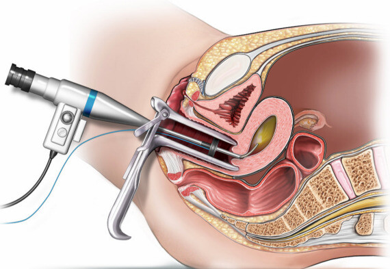 Phẫu thuật nội soi tử cung qua đường âm đạo. Nguồn ảnh: barmadehospital.com