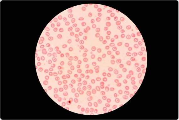 Hồng cầu nhỏ bất thường là một dấu hiệu của thalassemia. Nguồn ảnh: Azolifesciences.com