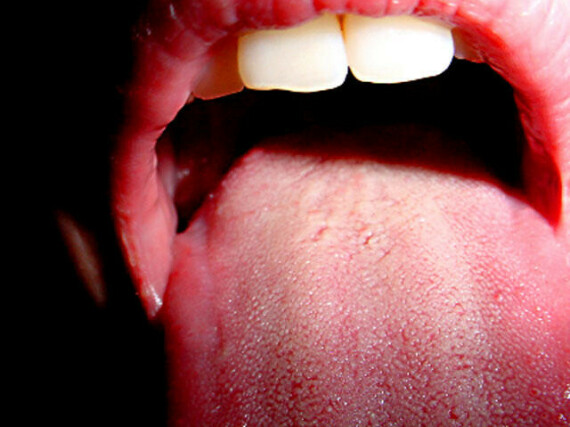 Số ca mắc ung thư vòm họng do HPV ngày càng gia tăng. Nguồn ảnh: www.cbsnews.com