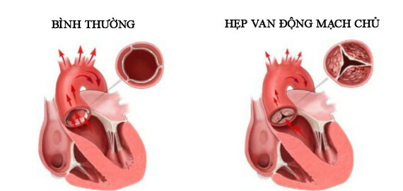 Hẹp van động mạch chủ. Nguồn ảnh: johnmuirhealth.com