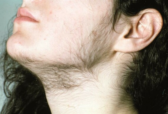 Mọc lông ở mặt là triệu chứng thường gặp của phụ nữ mắc hội chứng buồng trứng đa nang. (Nguồn ảnh independentnurse.co.uk)