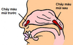 Hai loại chảy máu mũi. Nguồn: thaythuocvietnam.vn