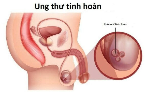 Hình ảnh minh họa khối u trong ung thư tinh hoàn ( dịch từ nguồn: https://www.urologisttijuana.com/)