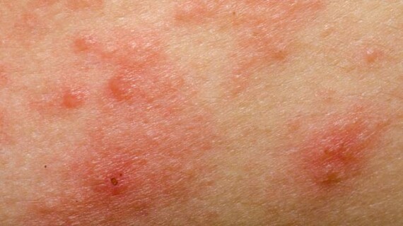 Chàm dị ứng gây ngứa và đỏ da. Nguồn ảnh: healthline.com