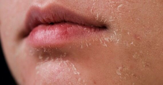 Da khô, tróc vảy, cảm giác châm chích nhẹ nóng đỏ hoặc rát da là tác dụng phụ phổ biến trong thời gian đầu sử dụng Adapalene/Differin. Nguồn ảnh: usmagazine.com