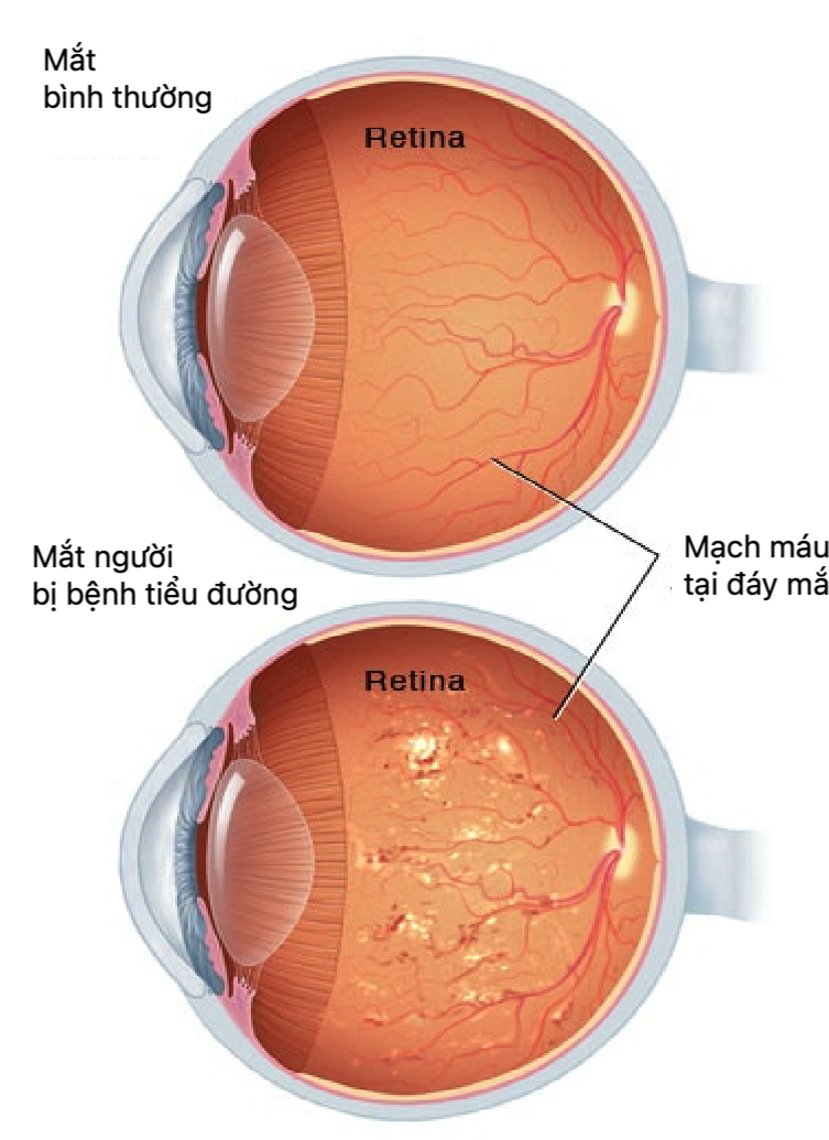 Bệnh võng mạc tiểu đường có thể được theo dõi qua khám đáy mắt (Nguồn ảnh: https://www.mayoclinic.org)