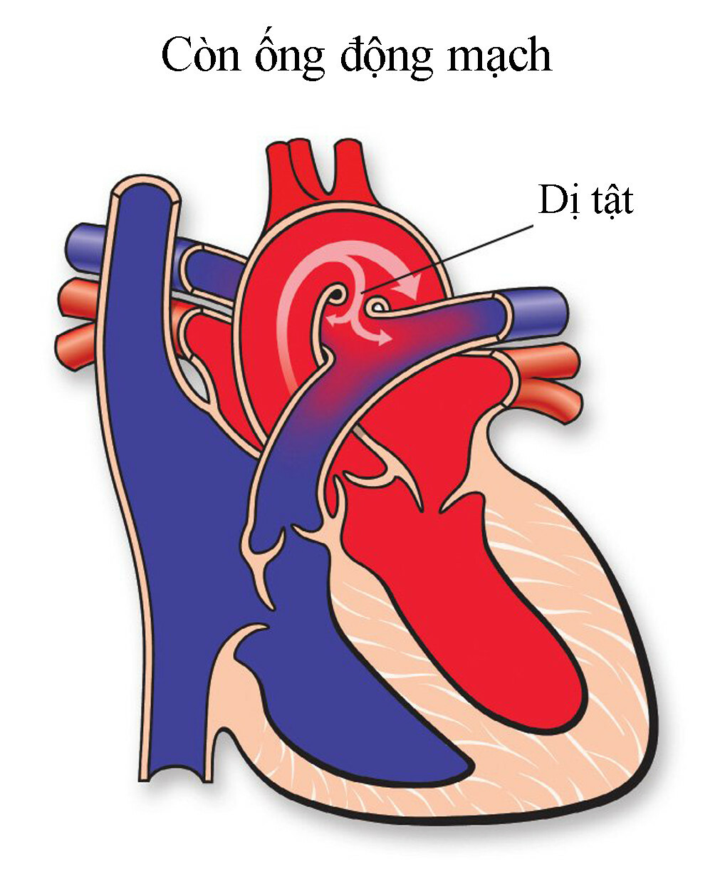 Còn ống động mạch. Nguồn ảnh: heart.org