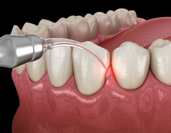 Điều trị nha chu ngoài tạo mô quanh răng khỏe mạnh còn mang lại nhiều lợi ích toàn thân. Nguồn ảnh: https://vistadentistry.com/