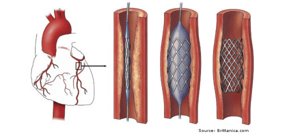 Đặt stent mạch vành. Nguồn ảnh quora.com