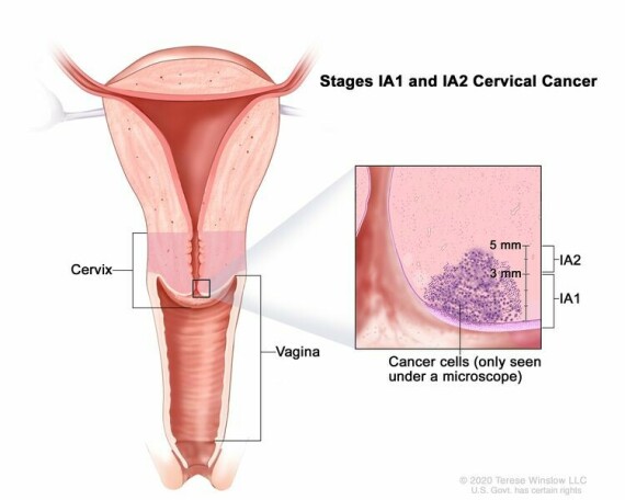 Ung thư cổ tử cung giai đoạn IA1 và IA2. Một lượng rất nhỏ ung thư chỉ có thể nhìn thấy dưới kính hiển vi được tìm thấy trong các mô của cổ tử cung. Ở giai đoạn IA1, ung thư không sâu quá 3 mm. Ở giai đoạn IA2, ung thư sâu hơn 3 mm nhưng không quá 5 mm.