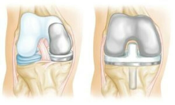 (Trái) Thay một phần khớp gối là một lựa chọn khi tổn thương chỉ giới hạn ở một phần của khớp. (Phải) Thay thế toàn bộ khớp gối.