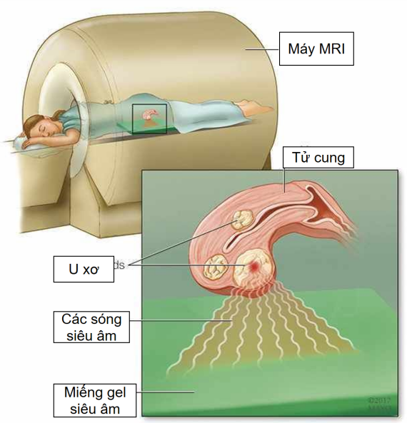 Phương pháp siêu âm hội tụ dùng trong điều trị u xơ tử cung (nguồn ảnh: https://www.huffpost.com/)