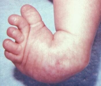 Bàn chân khoèo - Hình ảnh WikiCommonsBàn chân khoèo là một dị tật bẩm sinh