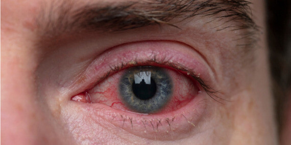 Sau phẫu thuật, nếu gặp các dấu hiệu như mắt đỏ nghiêm trọng, đau mắt không giảm, chớp sáng…bạn hãy đi khám ngay lập tức. (nguồn: aao.org)