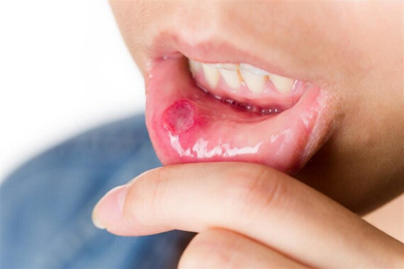 Thiếu vitamin B2 có thể gây ra các vết loét ở niêm mạc miệng. Nguồn ảnh: inf.news
