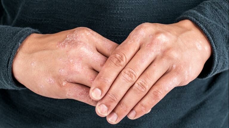 Following the trail: How treating psoriasis could improve heart health |  NHLBI, NIHNguồn: nhlbi.nih.gov