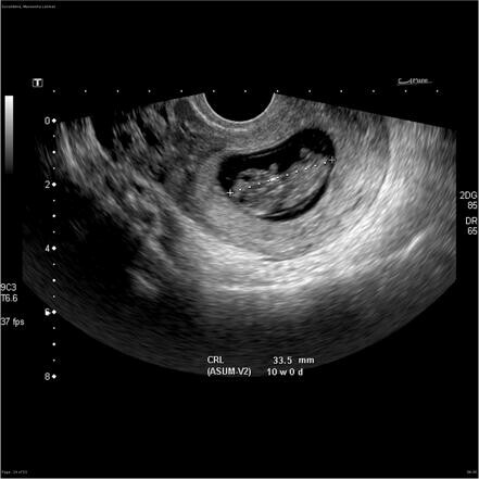 Hình ảnh siêu âm thai sớm. Nguồn: Radiopedia