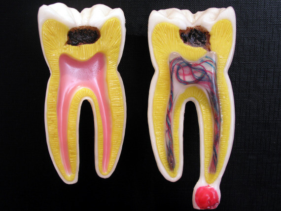 Viêm tủy tạo áp xe quanh chân răng (nguồn dentalhealthsociety)