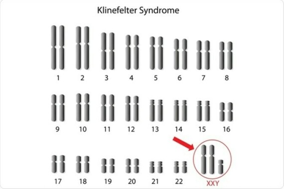 Bất thường bộ nhiễm sắc thể(NST) ở người mắc hội chứng Klinefelter (nguồn ảnh: https://www. news-medical.net/)