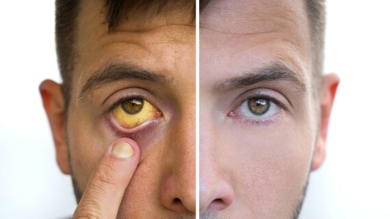 Vàng da, vàng mắt là triệu chứng dễ nhận biết của tăng bilirubin máu. Nguồn ảnh: Healthdigest.com
