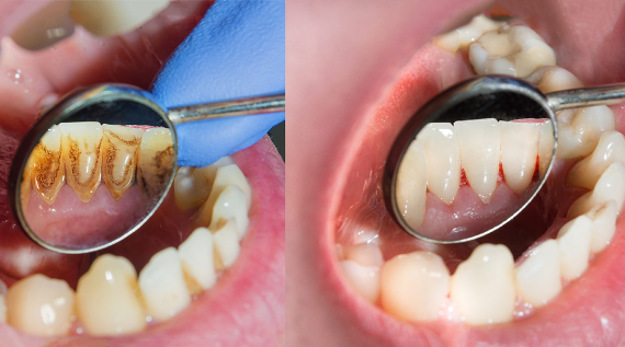 Hãy đi khám răng miệng định kì 6 tháng một lần để được loại bỏ cao răng bởi nha sĩ. (nguồn: holisticsmilecare.com)