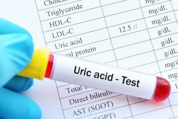 Xét nghiệm axit uric qua mẫu máu hoặc mẫu nước tiểu. Nguồn ảnh: forgout.com