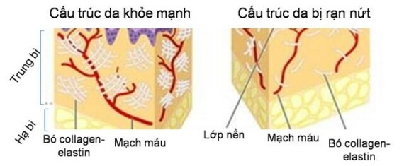 Tổn thương bó collagen và các sợi đàn hồi khiến da xuất hiện các vết rạn. Nguồn ảnh: https://vienthammynhathan.com/