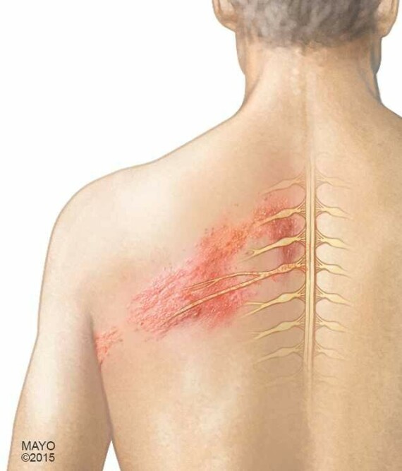 Tổn thương da và tổn thương thần kinh do HerpesNguồn: WV Acupuncture