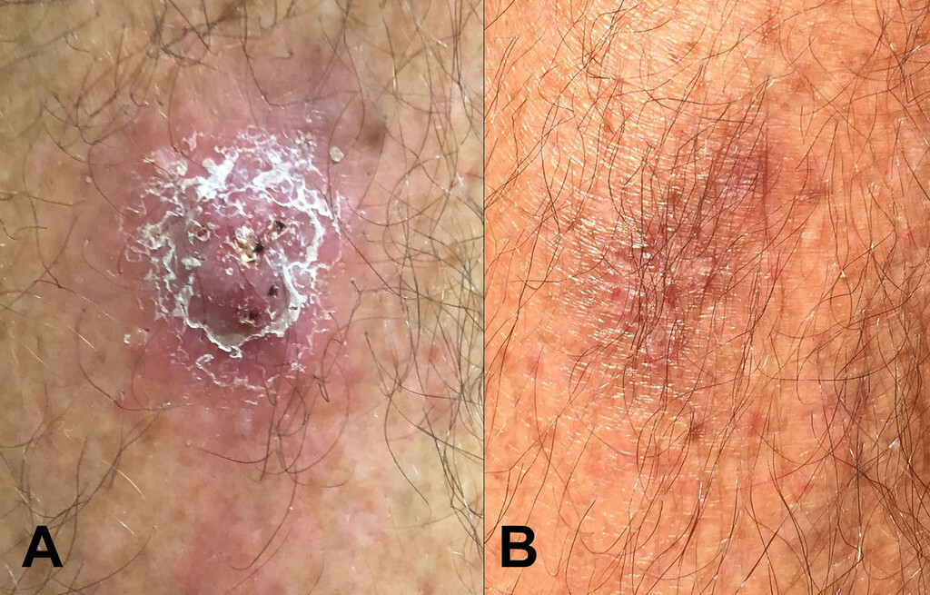 (A) Vùng da tổn thương do melioidosis. (B) Tổn thương đã hết sau 3 tháng điều trị bằng kháng sinh đường uống đơn độc. Nguồn ảnh: ajtmh.org