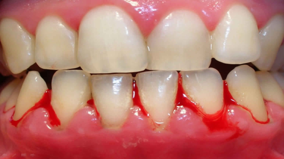 Lợi sưng, đỏ, chảy máu lợi khi đánh răng hoặc dùng chỉ nha khoa là dấu hiệu điển hình của viêm lợi.   (nguồn: healthjade.net)