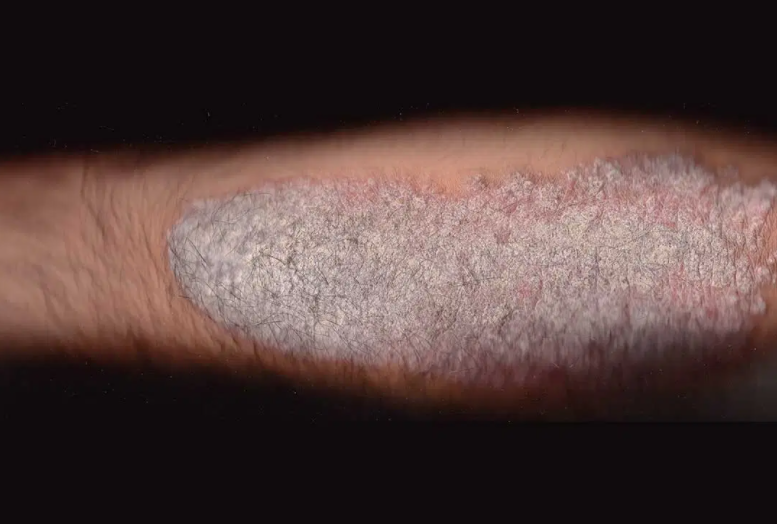 Bệnh vẩy nến cổ điển khiến các mảng vảy da dày, ngứa ở những vị trí như khuỷu tay, đầu gối. (nguồn ảnh: Wikimedia Commons)