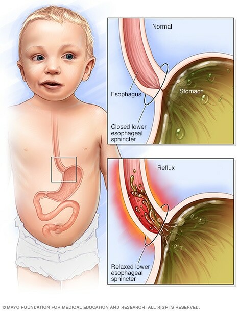 Infant reflux - Symptoms and causes - Mayo ClinicTNDDTQ nếu không điều trị kịp thời sẽ có thể để lại biến chứng nghiêm trọng với trẻ. Ảnh: Mayo Clinic.
