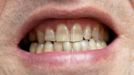 Các trường hợp màu sắc răng bị nhiễm tetracyclin rất khó để tẩy trắng, nên nghĩ đến các phương án làm trắng răng khác như veneer, mão răng…(nguồn: stanleysmiles.com)
