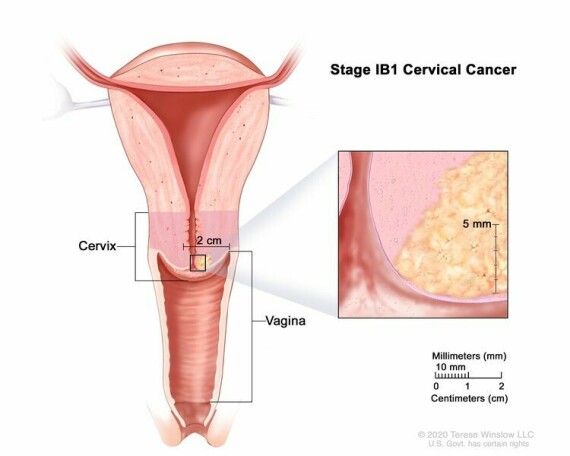Giai đoạn IB1 ung thư cổ tử cung. Ung thư có kích thước nhỏ hơn hoặc bằng 2 cm và sâu hơn 5 mm.