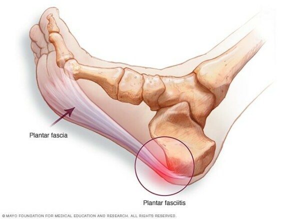 Cân gan chân và viêm cân gan chân. Nguồn ảnh mayoclinic.org
